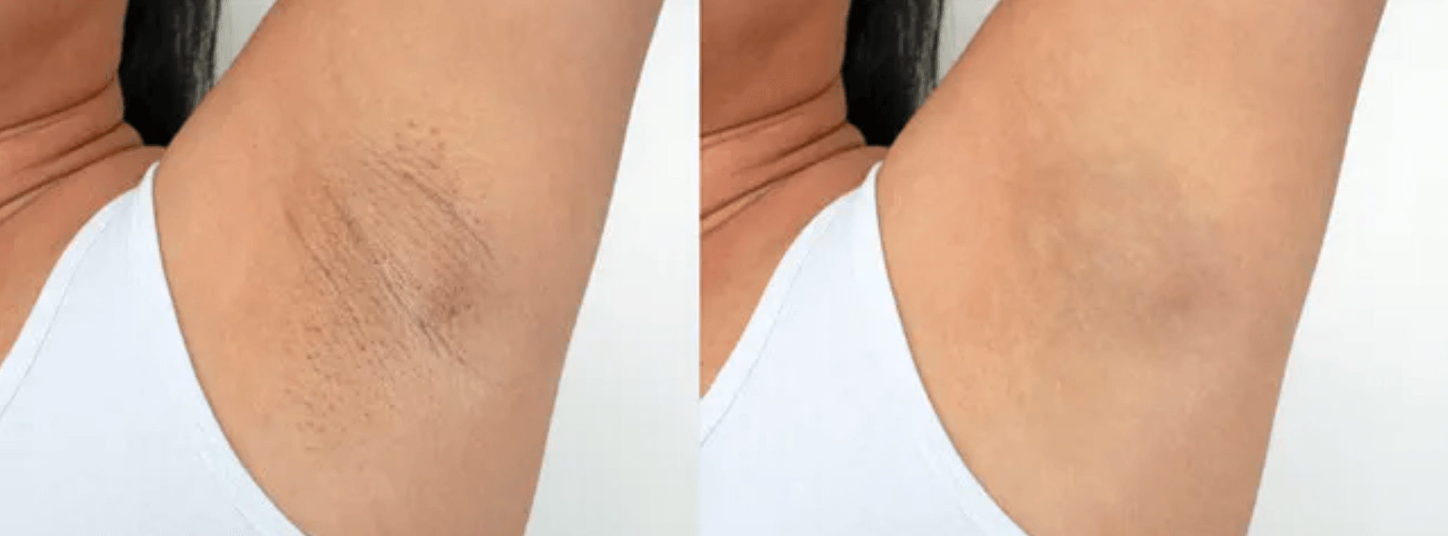 armpit photos before and after laser hair removal