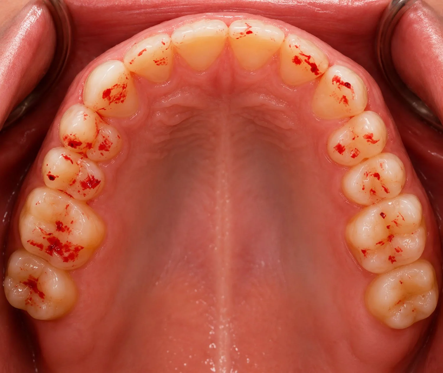 What Are Dental Articulating Films?