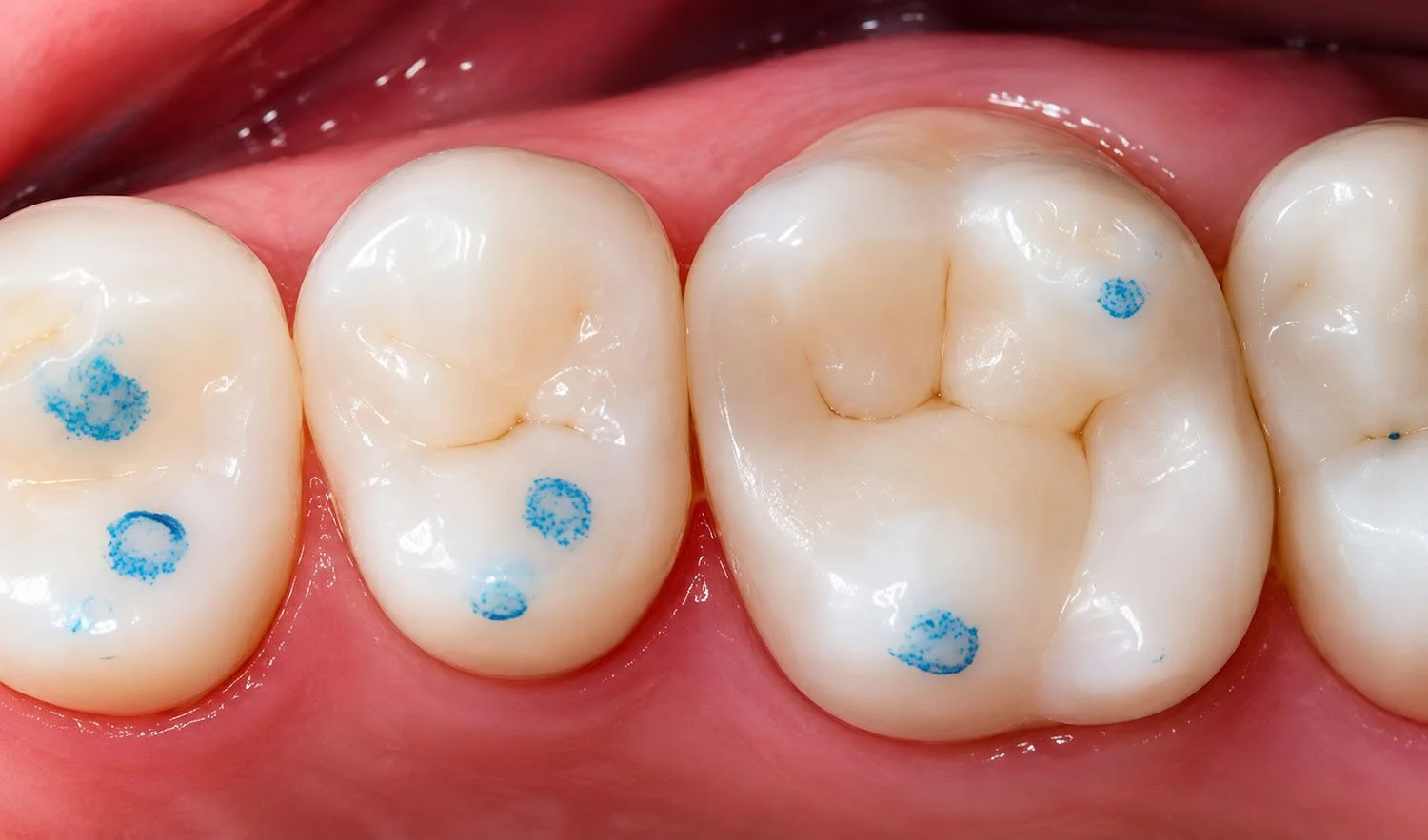 By understanding the principles and limitations of articulating paper, dentists can use this tool effectively to enhance patient care and achieve optimal occlusal balance.