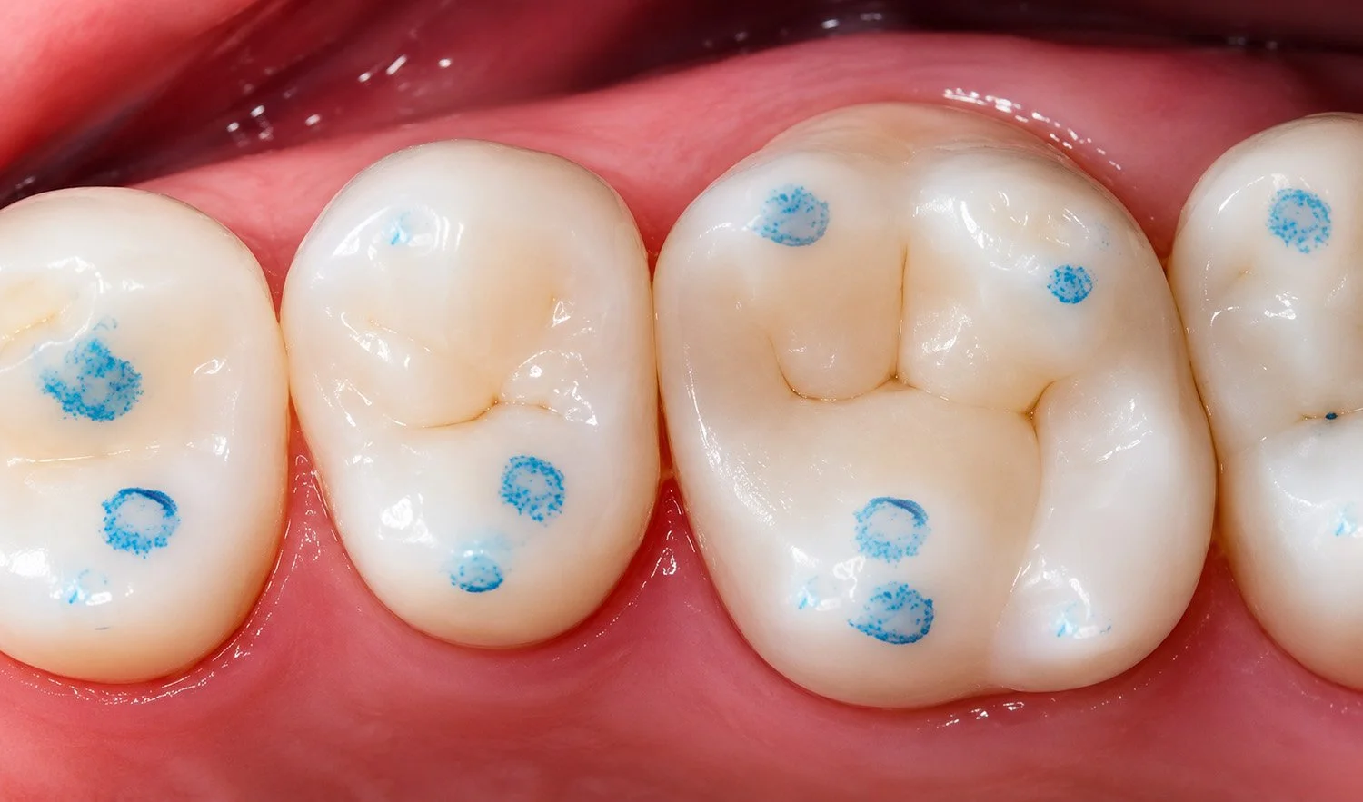 Dentists use blue, red, or a combination based on clinical needs. Blue is more sensitive and picks up lighter contact points. Red requires more pressure to leave a mark.