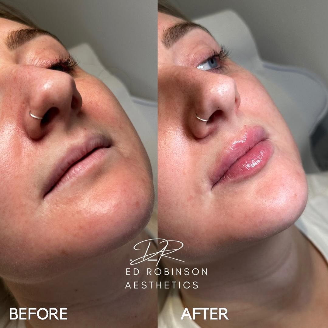 Before and immediately after 1ml of lip filler (with swelling). Immediate swelling is normal and will subside mostly by 48 hours and completely by 2 weeks.

My patient had lip filler from another practitioner dissolved and today we refilled them. Due