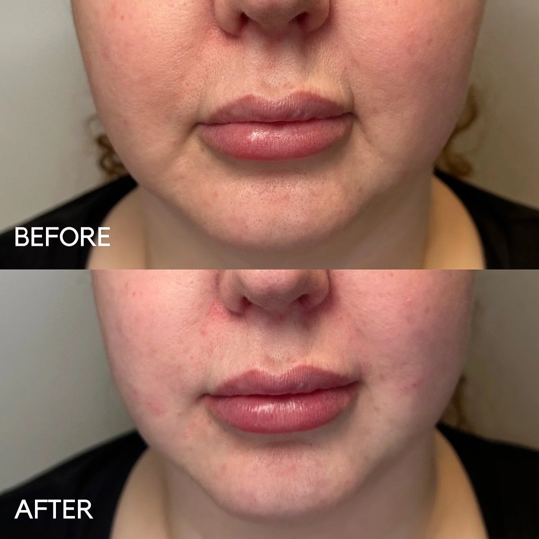 Like this post for this lip transformation ❤️🫦

My beautiful patient had already had lip filler previously and was happy with the volume. However, it had made the age-related volume loss around the mouth more prominent.

By providing support with 3m