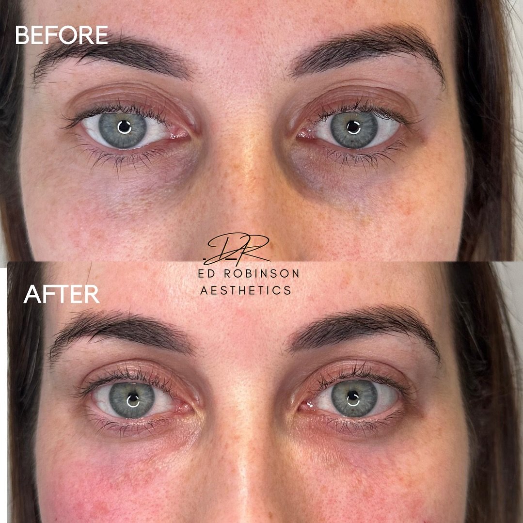 Let me know what you think of this before and after in the comments! 👀

Need under-eye rejuvenation for tired eyes? @ameela.uk polynucleotides working their magic here on the fabulous @dremmagoulding (who popped in to do my anti-wrinkle treatment to