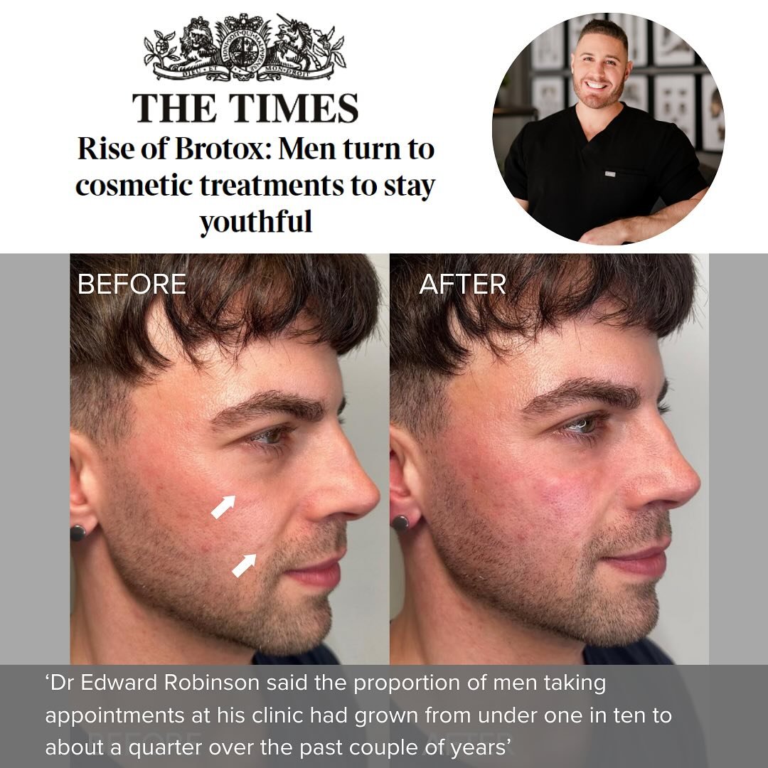 Many thanks to @thetimes for my feature (and including my patient before and after) about the rise in men&rsquo;s aesthetics procedures.

My patient had subtle under-eye rejuvenation and softening of the nasolabial fold with Belotero dermal filler fo
