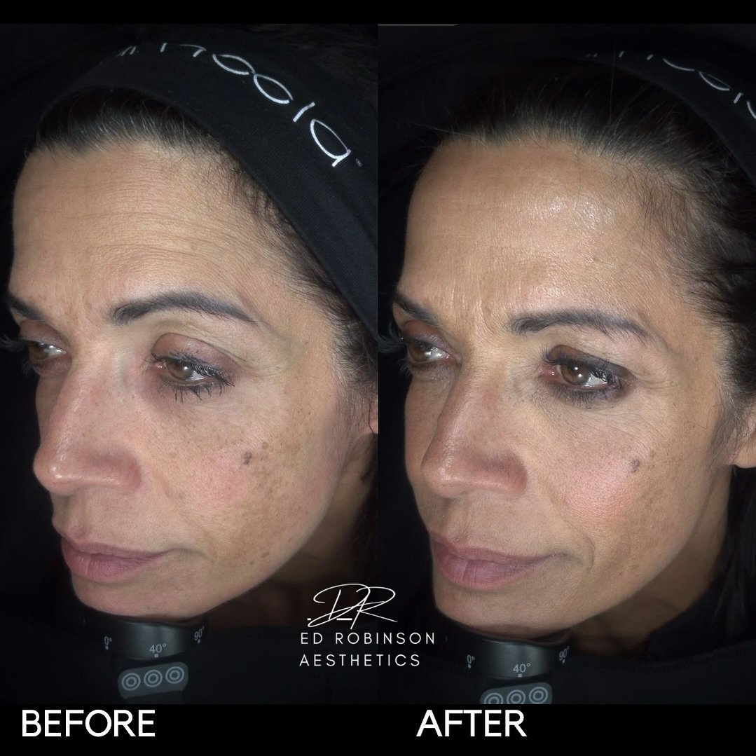 How fabulous does @jennypowelltv look following her @ameela.uk polynucleotides to the under-eye area and face, Microneedling and some PRP!?

Natural rejuvenation with no toxin or fillers is increasingly popular and you can see why. Just stimulating s