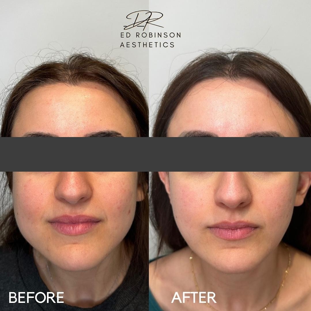 Did you know anti-wrinkle treatments can be used to treat teeth grinding and jaw-clenching? 🦷💥💉

My lovely patient had been experiencing significant symptoms which were affecting her sleep and stress throughout the day.

Following treatment to her