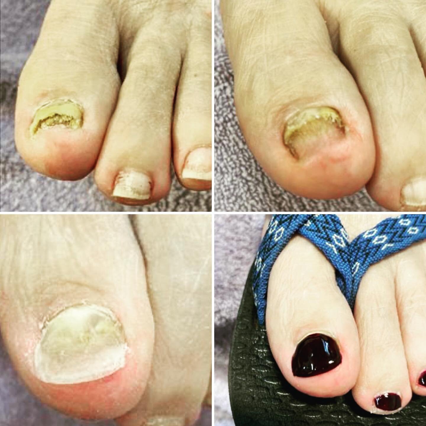 Toenail reconstruction can be very empowering for anyone. #toenails #toenailreconstruction #toenailremoval #fungaltoenails #certifiedmasterpedicurist #nanoflex #diabetictoes #solonailtechnician #terrehautenailtech #onpointpedi #pedicurist #diabeticpe