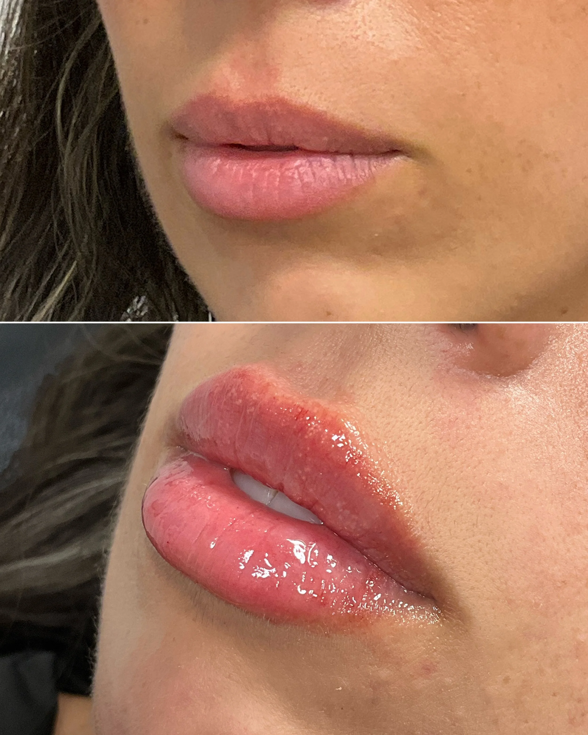 Your lips, but better.

Soft volume. Refined shape. A little more pout &mdash; without looking done.

The goal here wasn&rsquo;t to create a different lip. It was to enhance what she already had:
✨ More definition through the border
✨ Beautifully bal