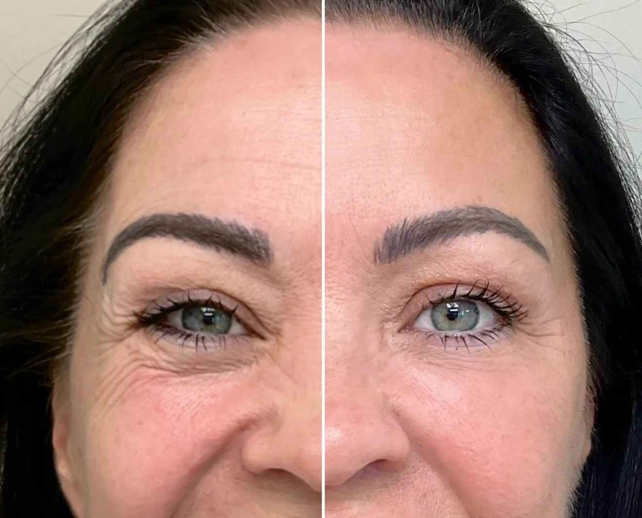 Proper placement of neuromodulator is not a cookie-cutter approach. The balance between elevators and depressors &mdash; and getting a natural, lifted outcome &mdash; takes skill and artistry.

Notice: 
&bull; lifted brow
&bull; open and awake eye
&b