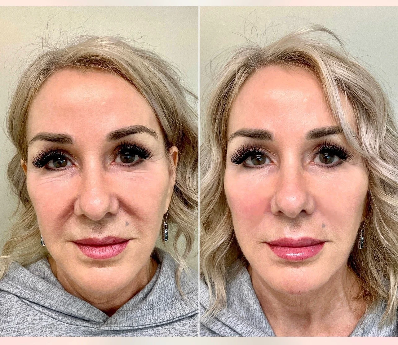 Full Face Treatment 