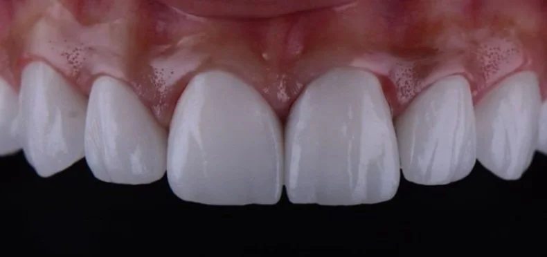 Implantes dentales en Bogotá