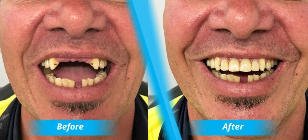 Partial Dentures Brisbane Denture Haus Partial Dentures Brisbane Denture Haus