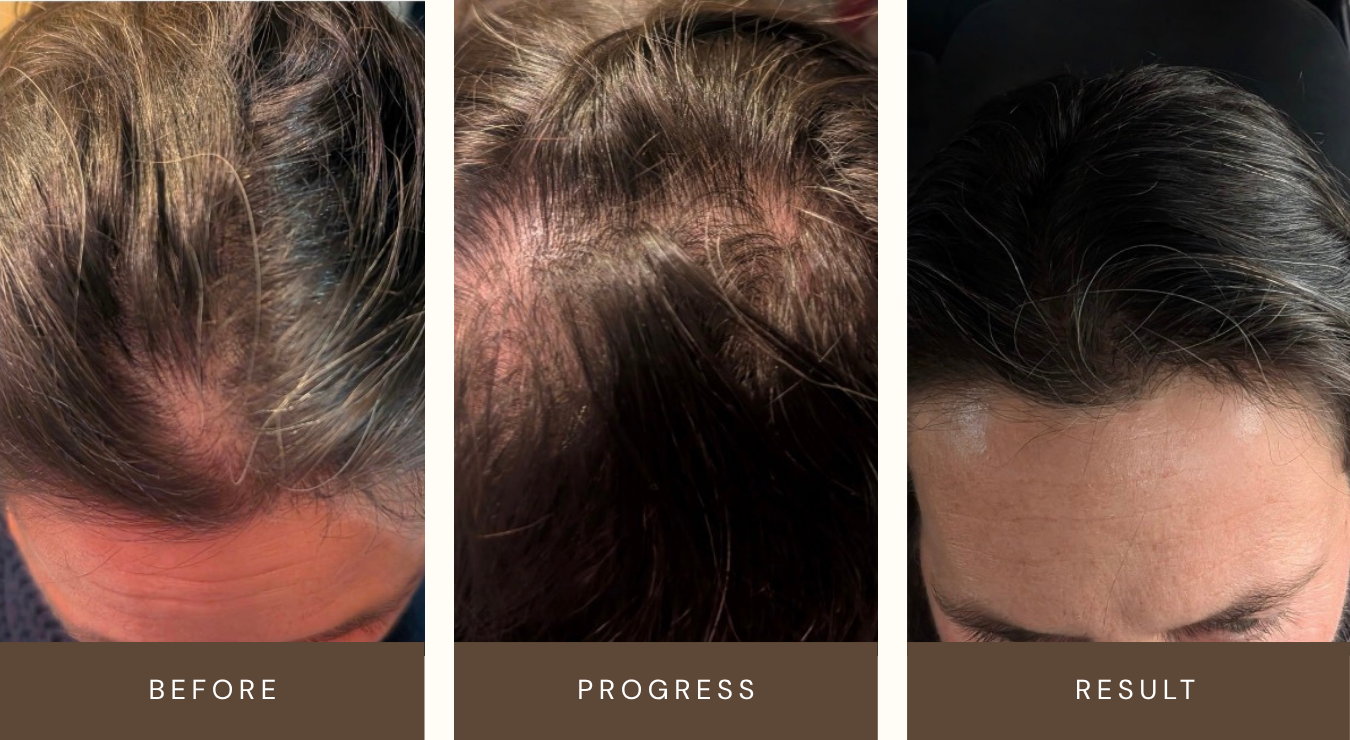 Comparison of a person's scalp before, during, and after hair regrowth treatment, showing thinning hair before, some hair growth during progress, and fuller hair after results.