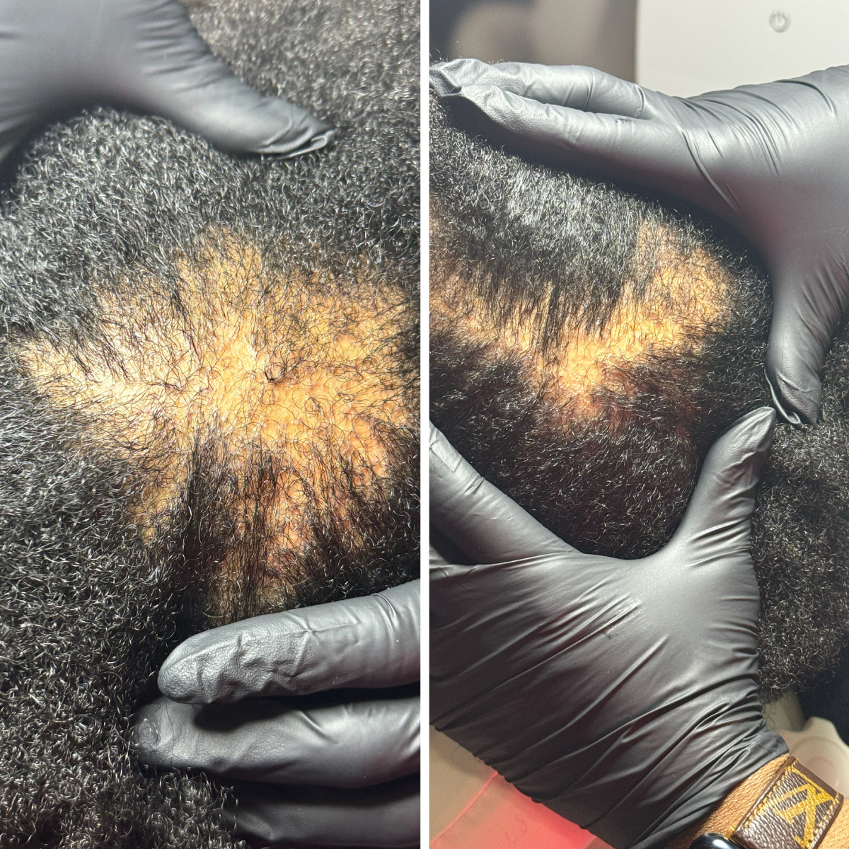 Close-up photos showing a person's scalp with hair loss, with a healthcare professional inspecting the area wearing black gloves.