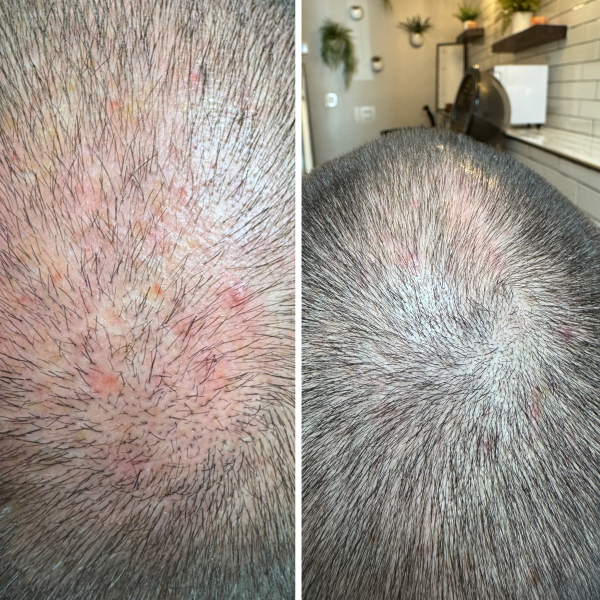 Close-up images of a person's scalp showing scalp irritation and hair regrowth after treatment.