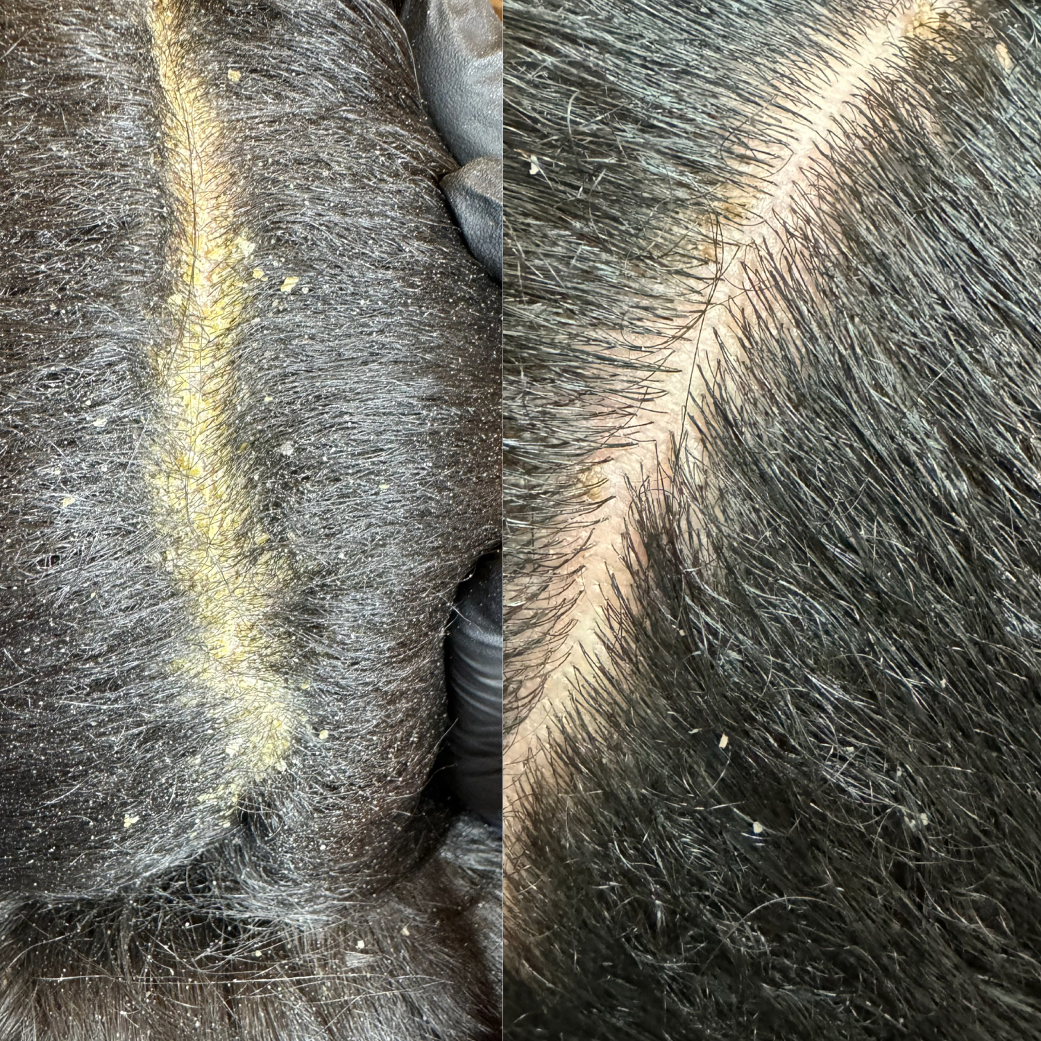 Close-up of a person's scalp showing hair thinning and dandruff, before and after treatment.