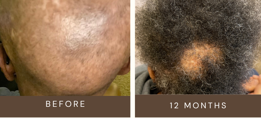 Comparison of scalp skin before and after 12 months showing hair growth progress