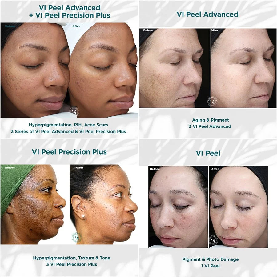 VI Peel treatment in Houston for acne and hyperpigmentation