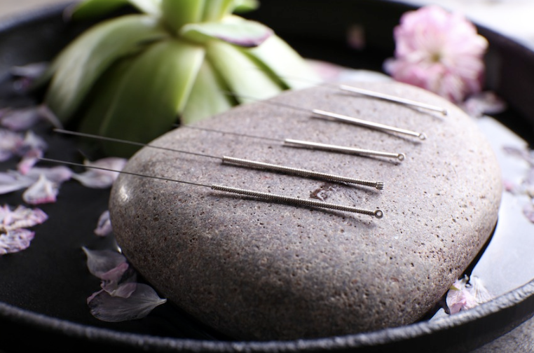 How Does Acupuncture Help Pain?