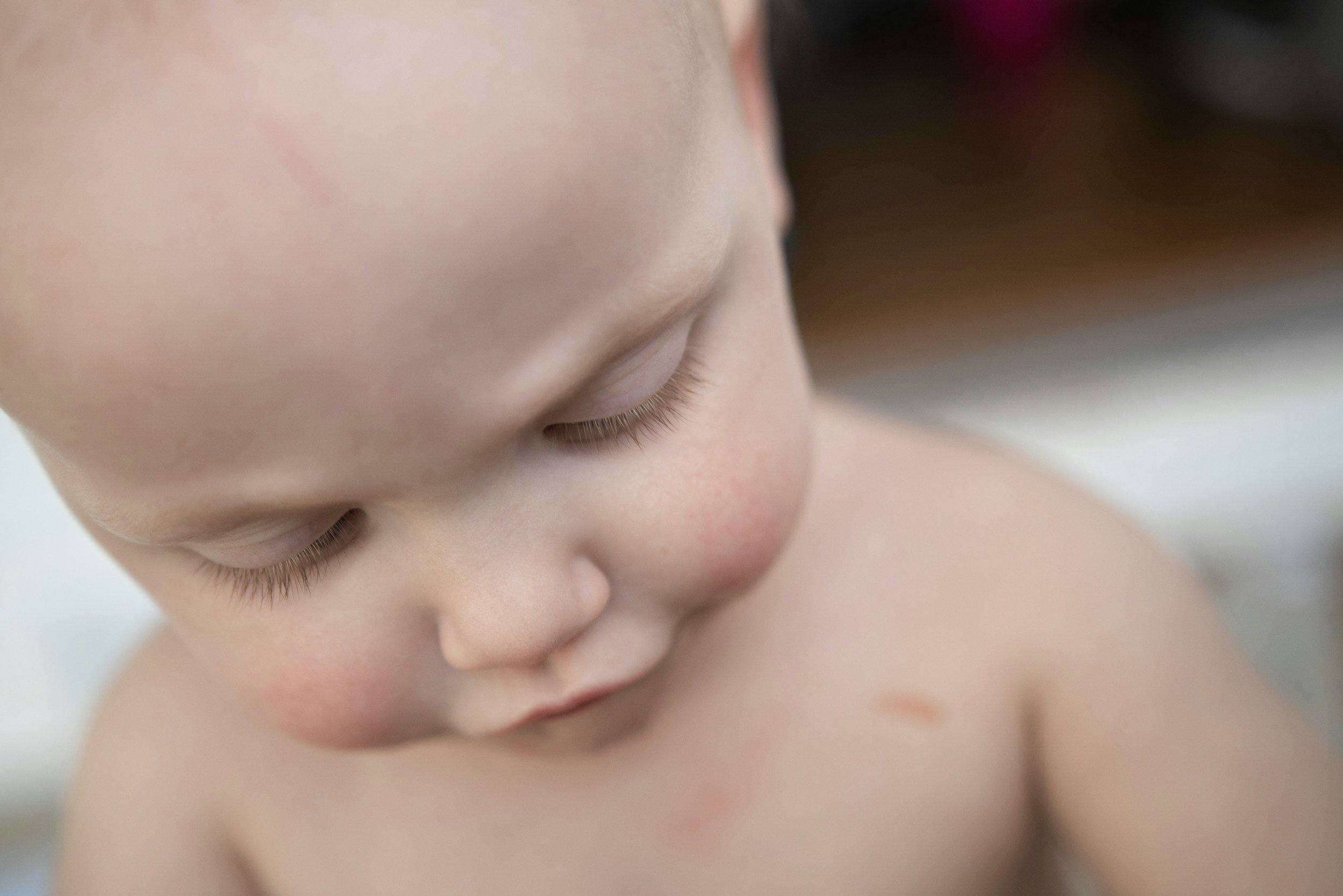 Baby and Childhood Eczema: Getting the Basics Right