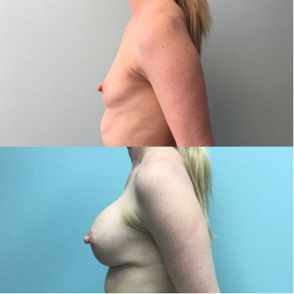 Breast-Augementation-Dr-Emily-Hu-2.png