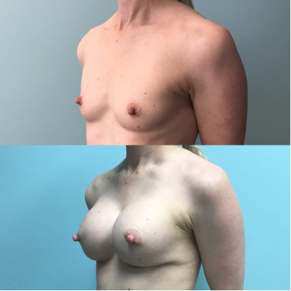 Breast-Augementation-Dr-Emily-Hu-1.png