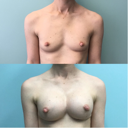 Breast-Augementation-Dr-Emily-Hu-3.png