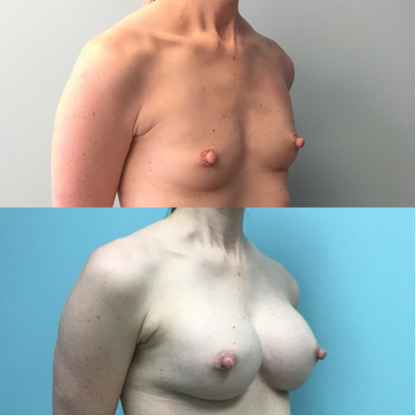 Breast-Augementation-Dr-Emily-Hu-4.png