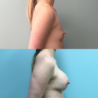 Breast-Augementation-Dr-Emily-Hu-5.png