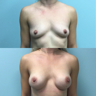 Breast-Augmentation-Dr-Emily-Hu-1.png