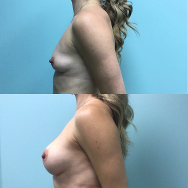 Breast-Augmentation-Dr-Emily-Hu-2.png
