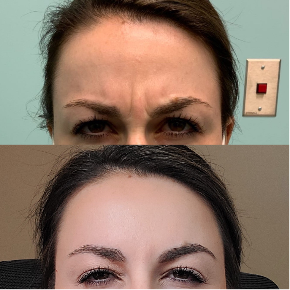 Botox-1-Emily-Hu.png