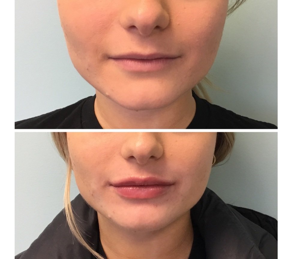 Lip-Filler-Dr.Emily-Hu-Before-and-After3.jpg