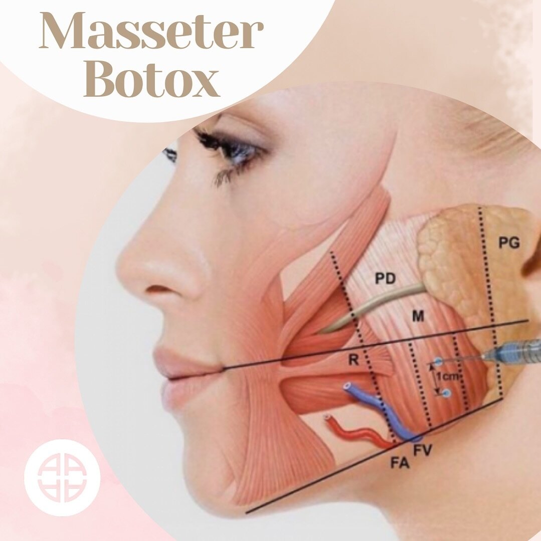 Let&rsquo;s talk about facial slimming with Masseter Botox! 🌸

Are you looking to achieve a more sculpted and slim lower face? Masseter Botox might be the perfect solution for you! By injecting Botox into the masseter muscle, you can achieve a more 