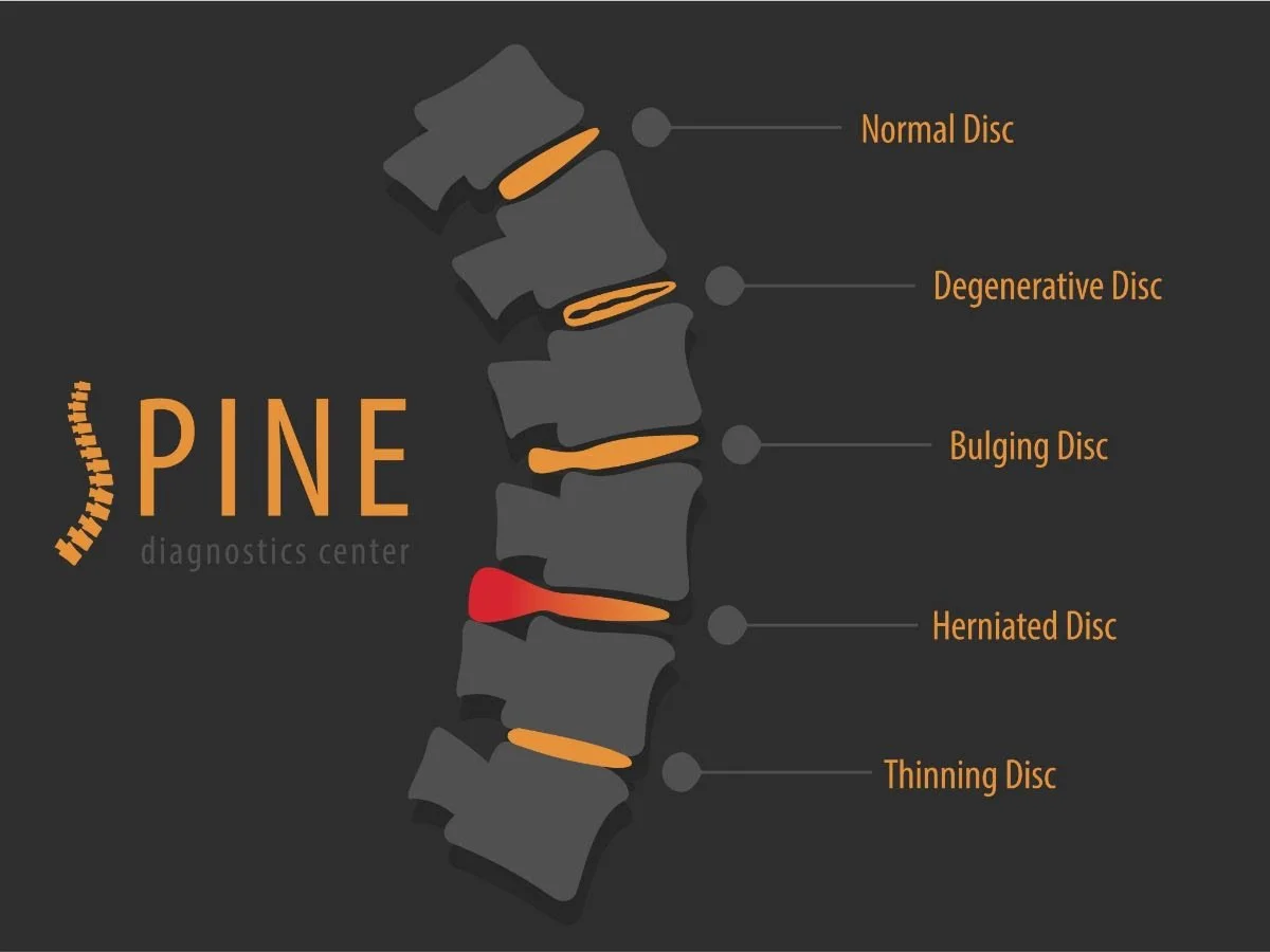 Discs Don't 'Slip' They Bulge — Shaftesbury Chiropractic Dorset