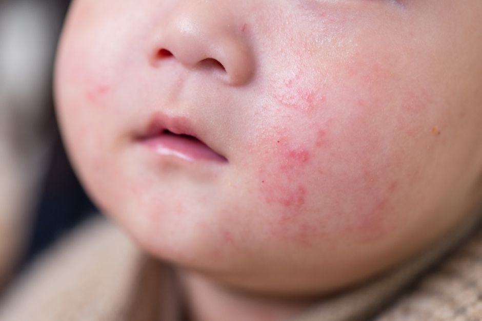 What to Do If Your Baby Has an Allergic Reaction