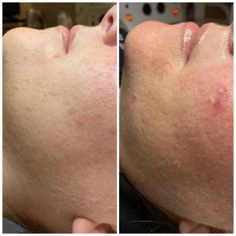 Facial Treatment