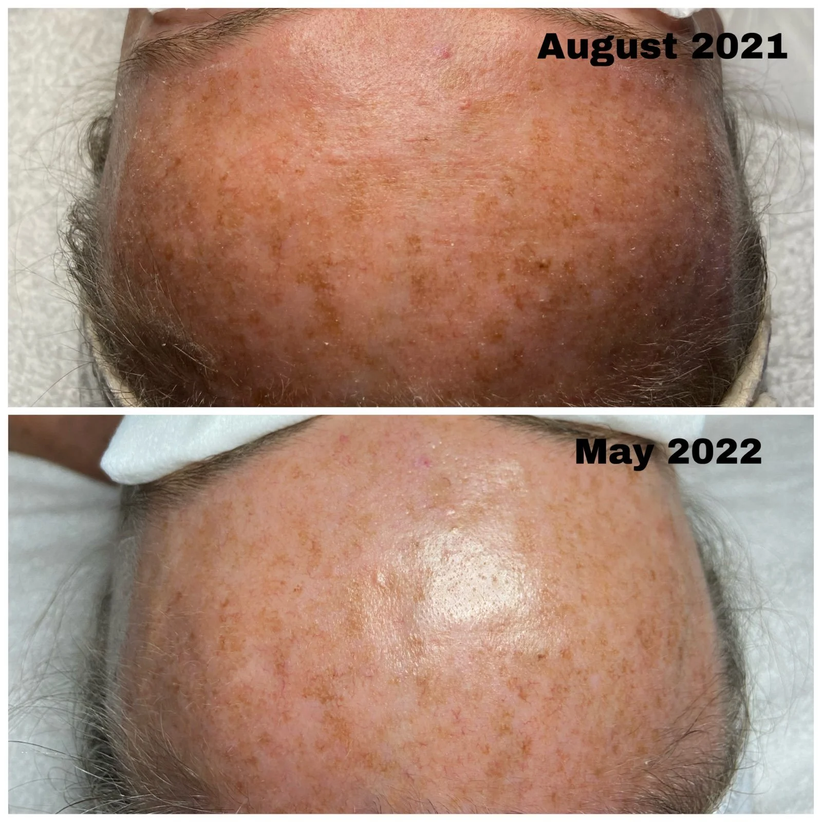 Acai Berry Peel - 5 round treatment