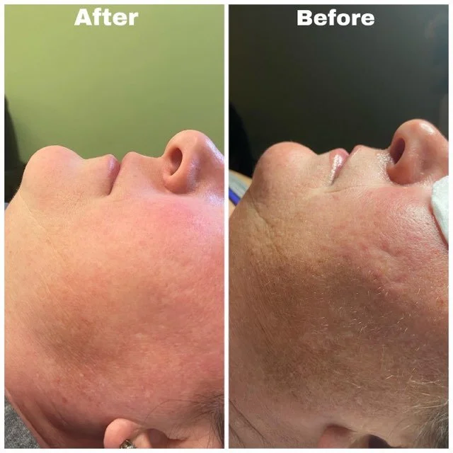 Facial Treatment