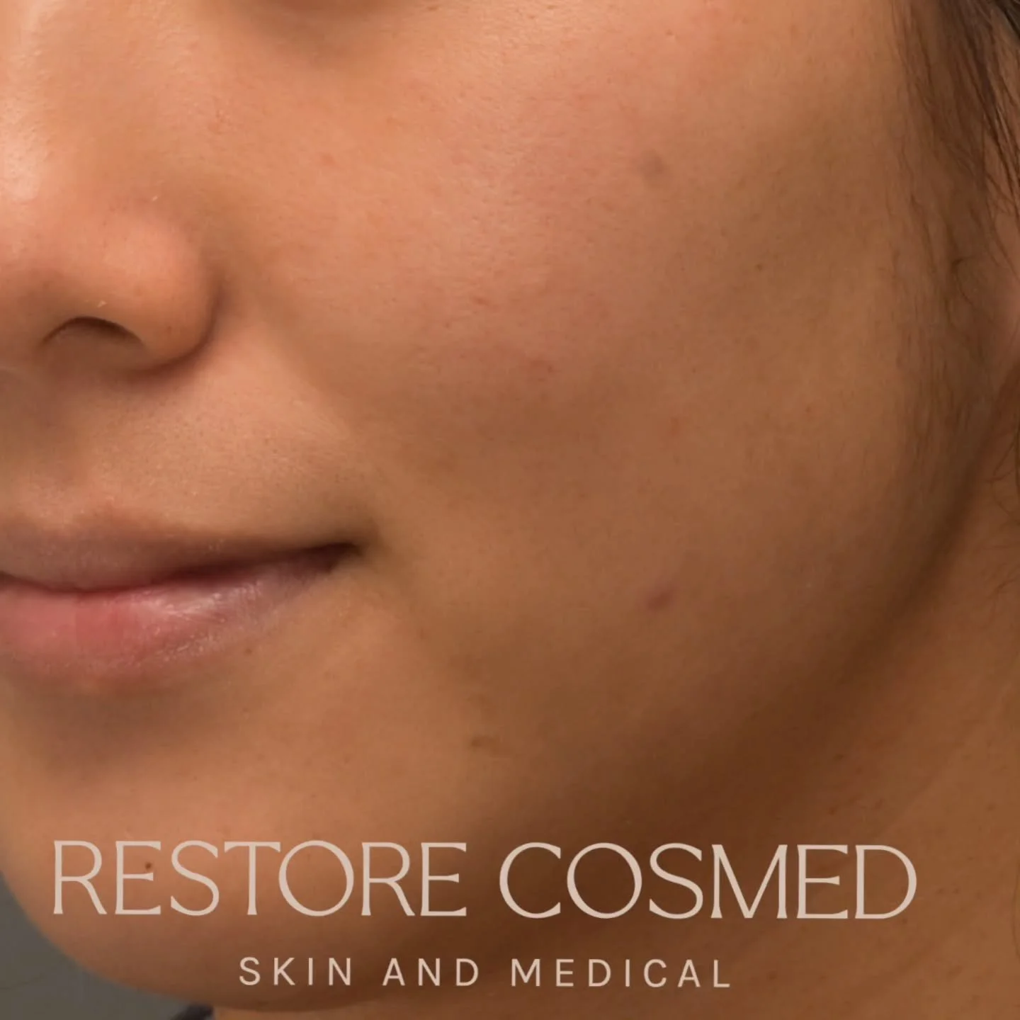 Before and after 6 sessions of Dermal Needling. 

Treating PIH from burns from a procedure at another clinic in a high risk skin type. 

These images beautifully show how medical dermal needling treats multiple skin concerns in one go. 
- look at the