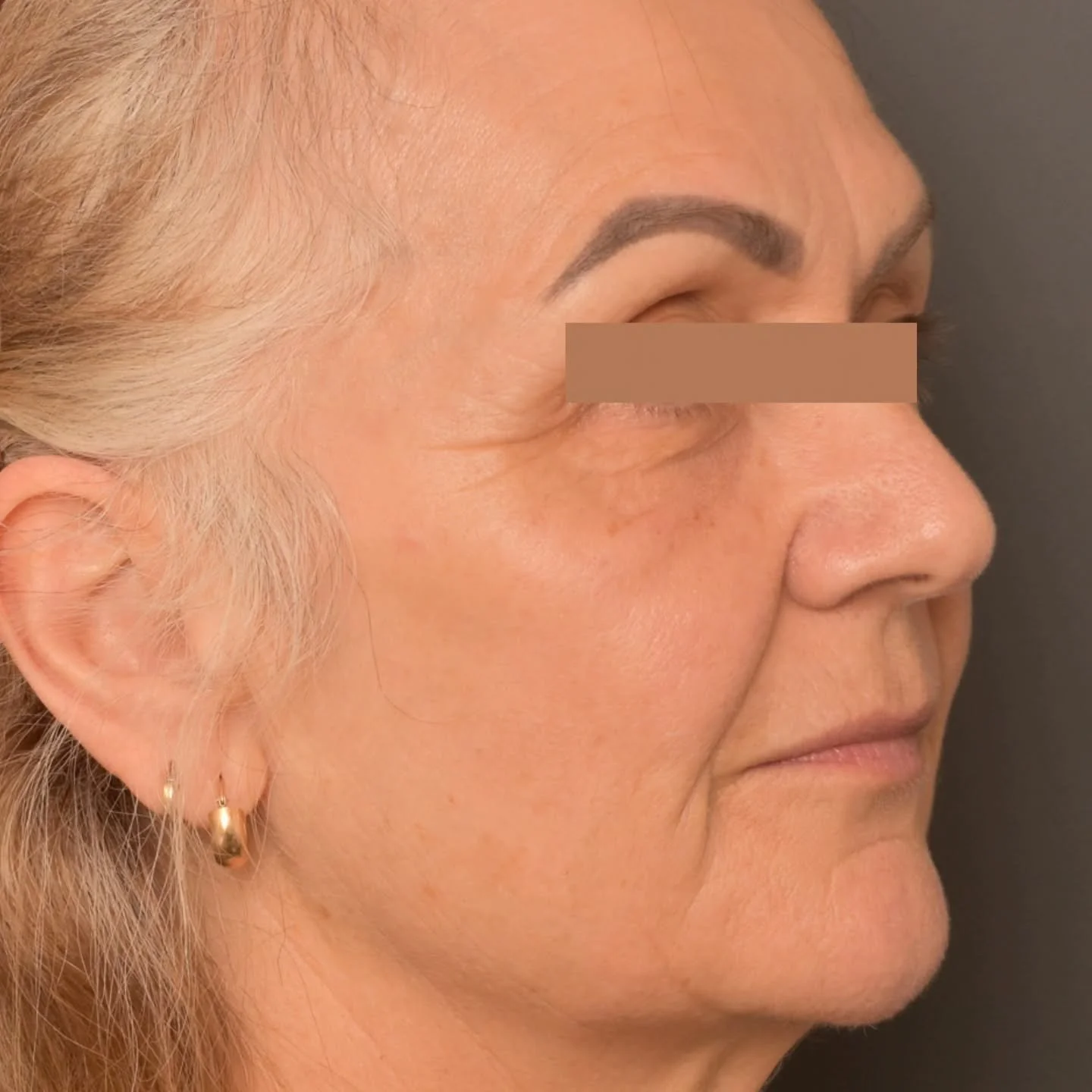 This beautiful patient of mine kindly agreed to be a model for a group of cosmetic doctors I was training in dermal filler.

I love teaching and think that training with anatomical precision in mind is what makes great injectors. 

Look at the beauti