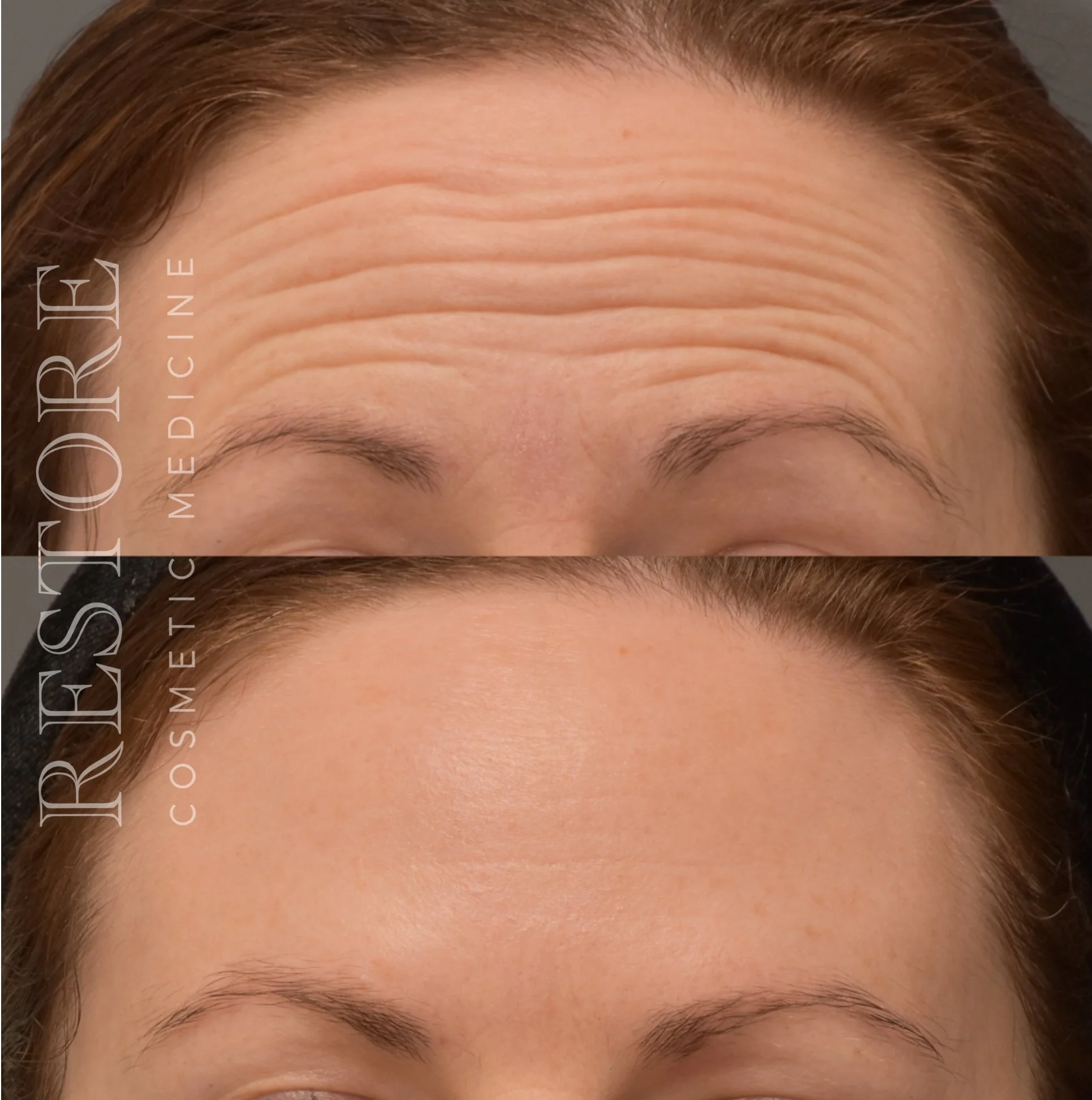 Before and after botulinum treatment to forehead