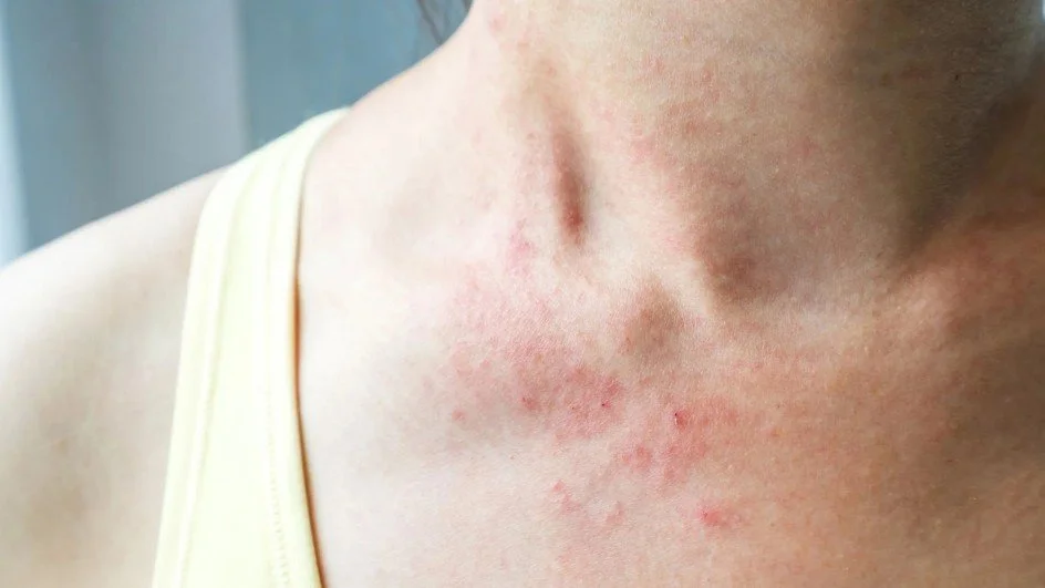 Close-up of a person's neck and upper chest with red skin irritation and rashes.