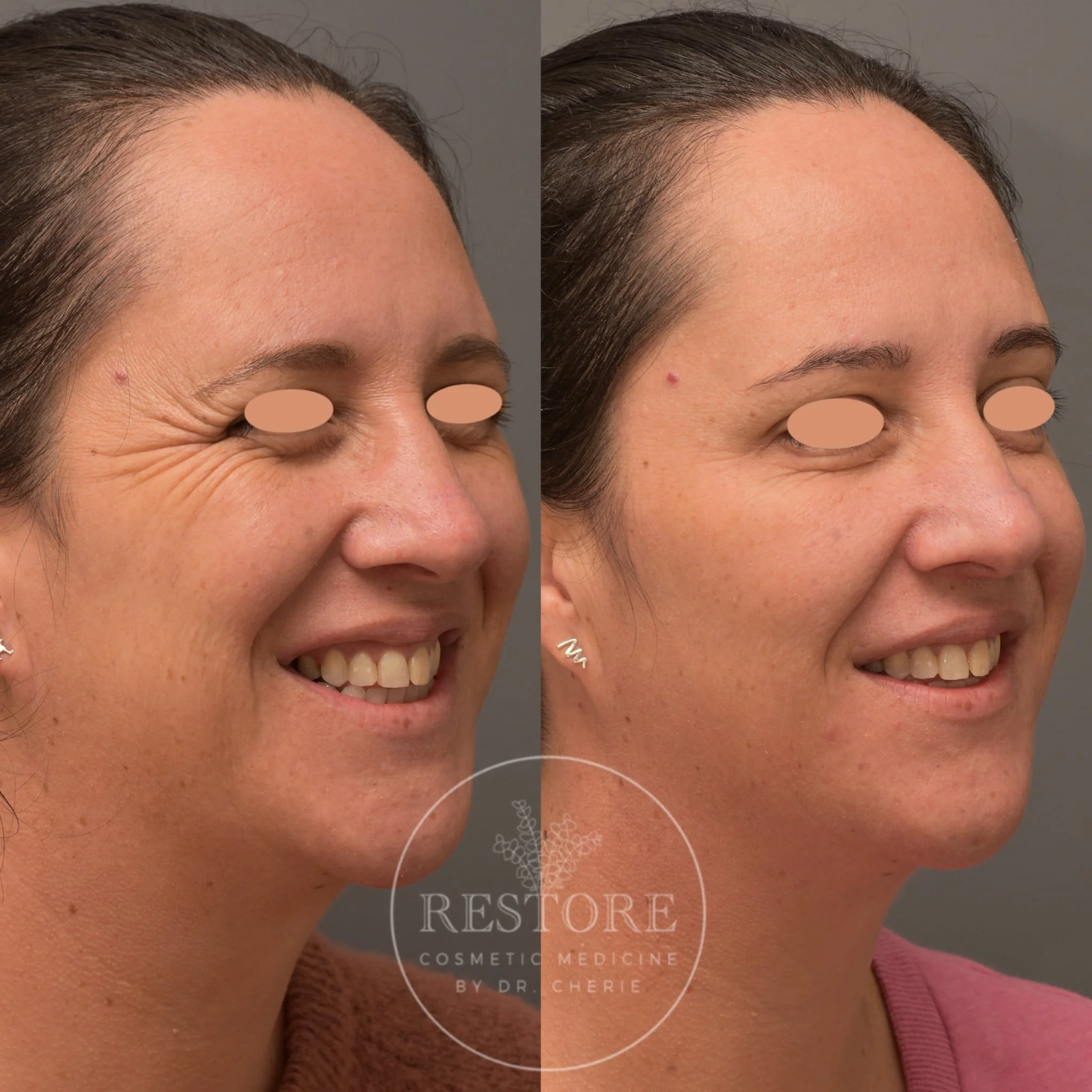 Anti wrinkle injections — Restore Cosmetic Medicine by Dr. Cherie Wyatt ...