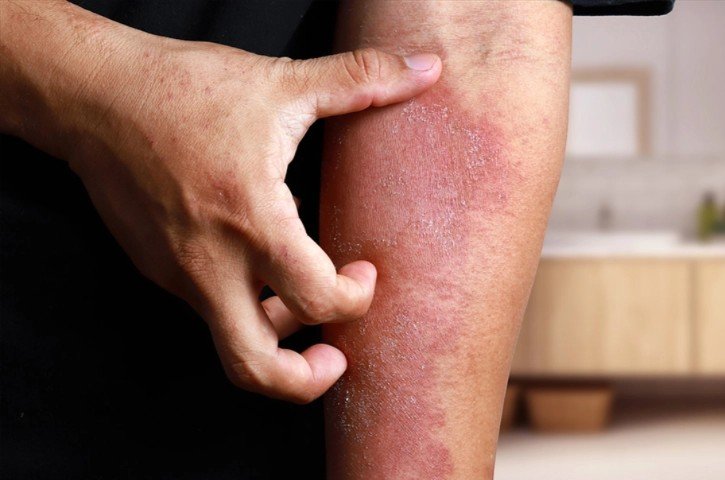 Person holding their arm, which is red and peeling, indicating skin irritation or rash.