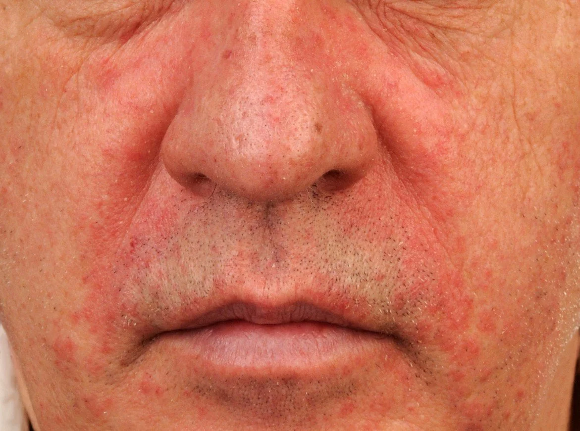 Close-up of a person's nose, upper lip, and surrounding facial skin showing redness, dryness, and inflammation.