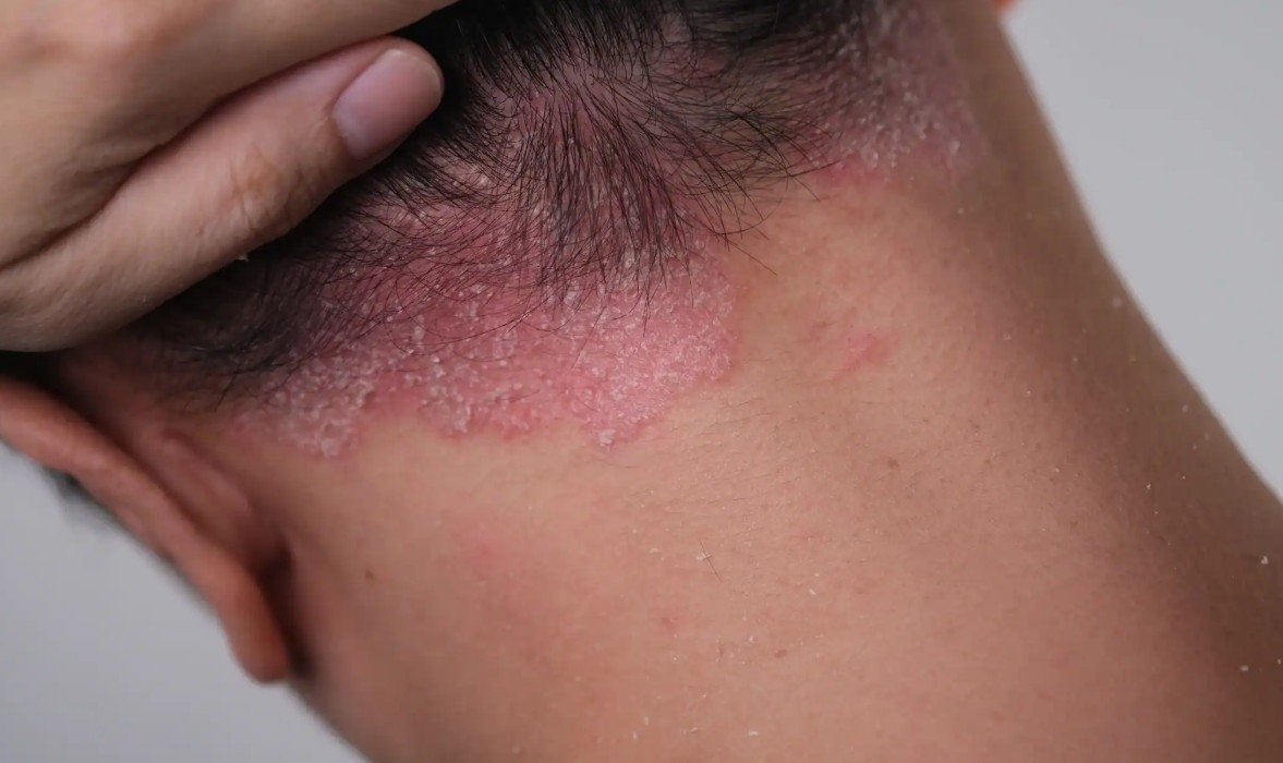 Close-up of a person's neck showing dry, purple, and red skin with peeling and irritation.