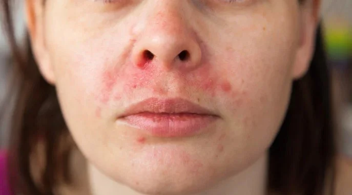 Close-up of a person's face showing red acne and skin irritation around the nose, cheeks, and chin.