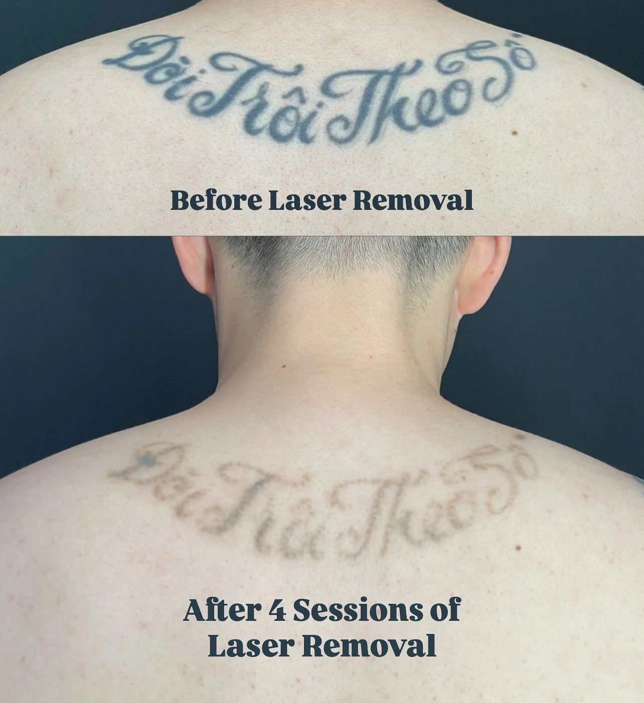 Tattoo Laser Removal