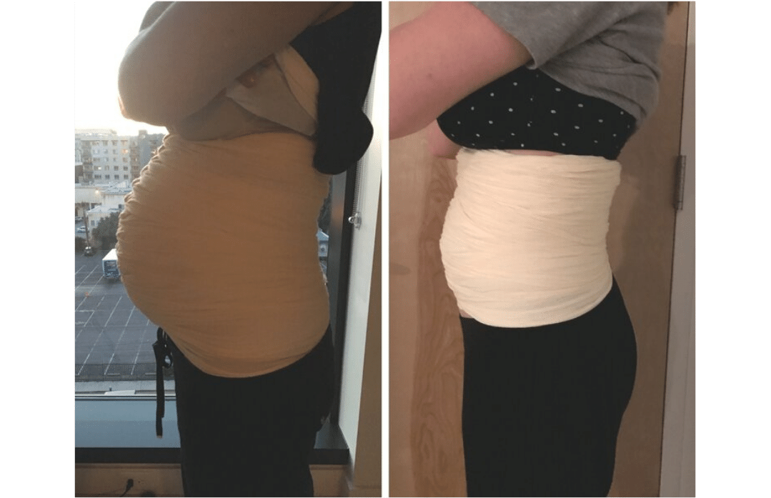 The Ab System - Pre & Postpartum Belly Wrapping System - CMT Medical